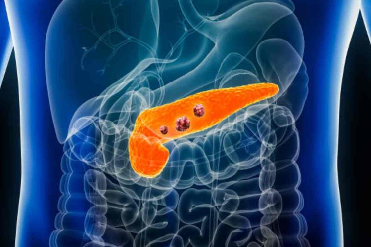 Tumore del pancreas, un nuovo farmaco riaccende la speranza