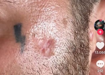 Salmo mostra la cicatrice del tumore alla pelle e riapre il dibattito sulle creme solari