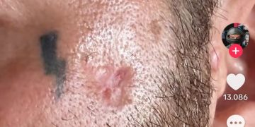 Salmo mostra la cicatrice del tumore alla pelle e riapre il dibattito sulle creme solari