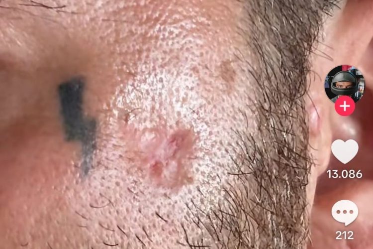 Salmo mostra la cicatrice del tumore alla pelle e riapre il dibattito sulle creme solari