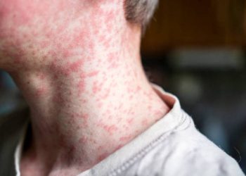 Morbillo, boom di casi in Italia: +46% in un anno, allarme tra non vaccinati e sanitari