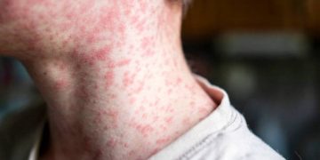 Morbillo, boom di casi in Italia: +46% in un anno, allarme tra non vaccinati e sanitari
