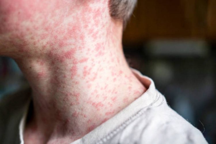 Morbillo, boom di casi in Italia: +46% in un anno, allarme tra non vaccinati e sanitari