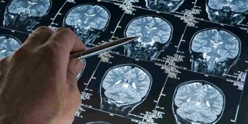 Tracciata la prima mappa del rischio genetico dell'Alzheimer