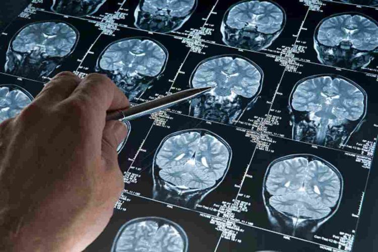 Tracciata la prima mappa del rischio genetico dell'Alzheimer