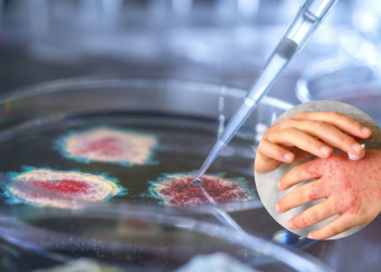 Mani con eruzioni cutanee e piastra Petri con pipetta in laboratorio. Malattia della pioggia, aumentano i casi in Europa: 123 infezioni confermate e sospetta trasmissione