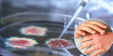 Mani con eruzioni cutanee e piastra Petri con pipetta in laboratorio. Malattia della pioggia, aumentano i casi in Europa: 123 infezioni confermate e sospetta trasmissione