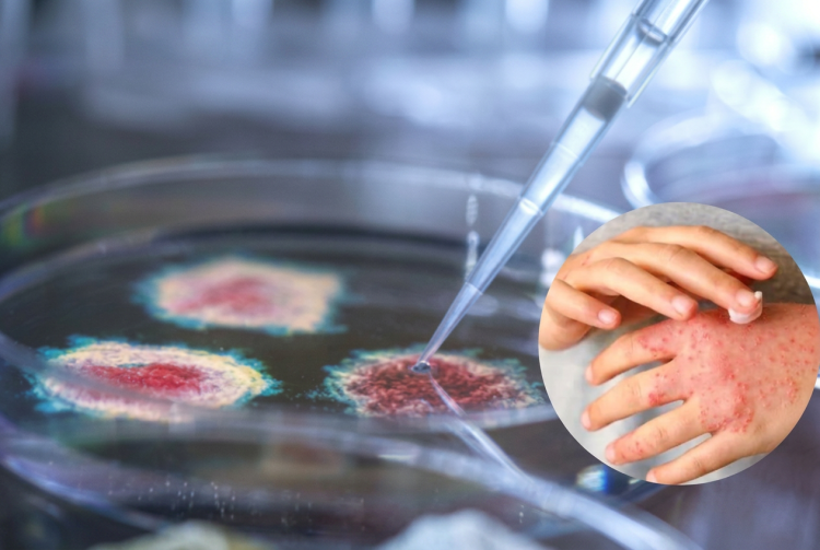 Mani con eruzioni cutanee e piastra Petri con pipetta in laboratorio. Malattia della pioggia, aumentano i casi in Europa: 123 infezioni confermate e sospetta trasmissione